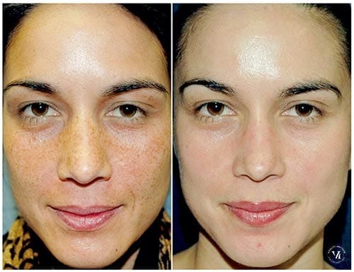 Chemical Peel Treatment: Is It Safe for Your Skin?